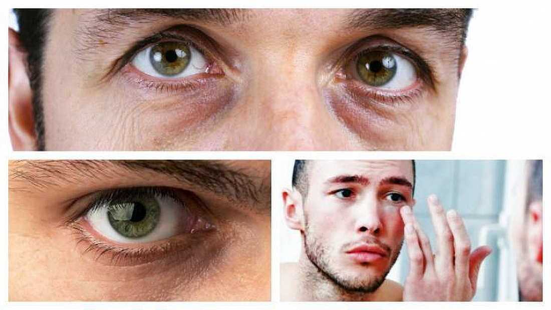 Мешки под глазами причина у мужчин лечение
