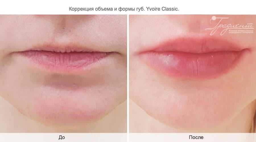Когда можно целоваться после губ. Формы губ для увеличения гиалуроновой кислотой. Увлажнение губ гиалуроновой кислотой. Увлажнение губ гиалуроновой кислотой до и после.