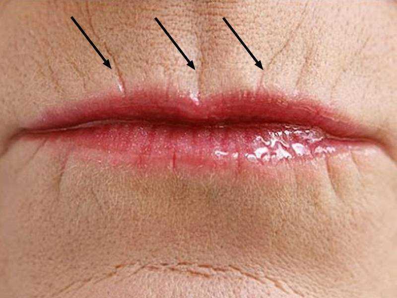 Кисетные морщины над верхней губой — как убрать у косметолога
