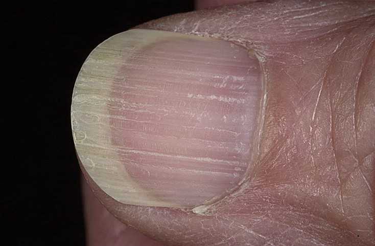 Желтые ногти: причины и лечение