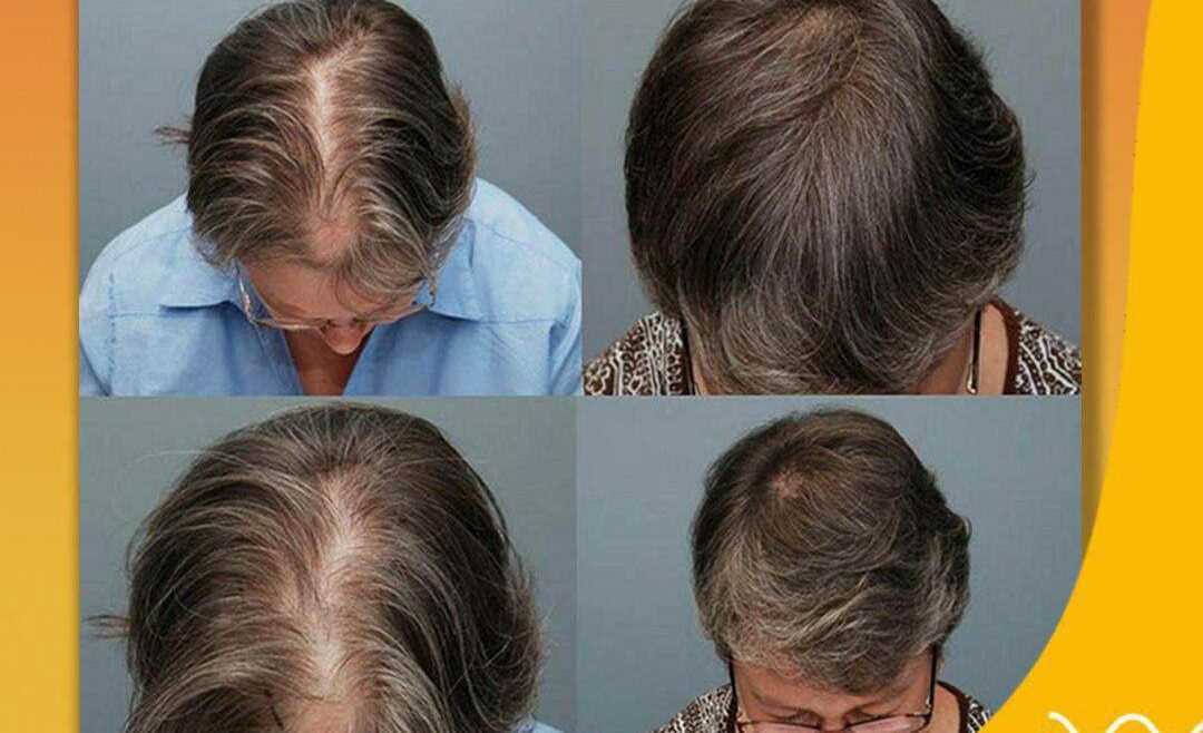 Причину выпадения волос после 40. Очень редкие волосы на голове.