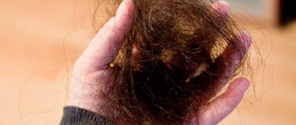 Могут ли выпадать волосы от переизбытка кальция