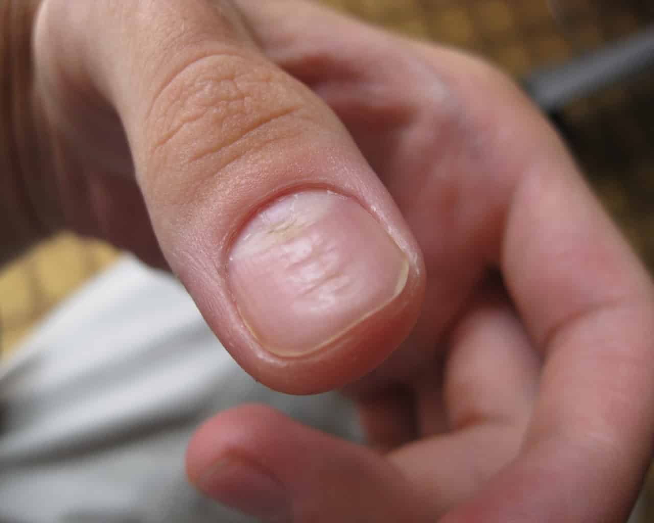 Неровные ногти: почему на них появляются точки, бугорки и бороздки