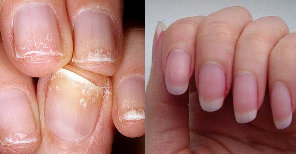 Как восстановить ногти после гель лака - отзывы