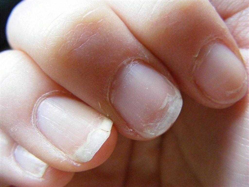 Почему желтеют ногти на руках — причины, диагностика и способы лечения, включая народные рецепты