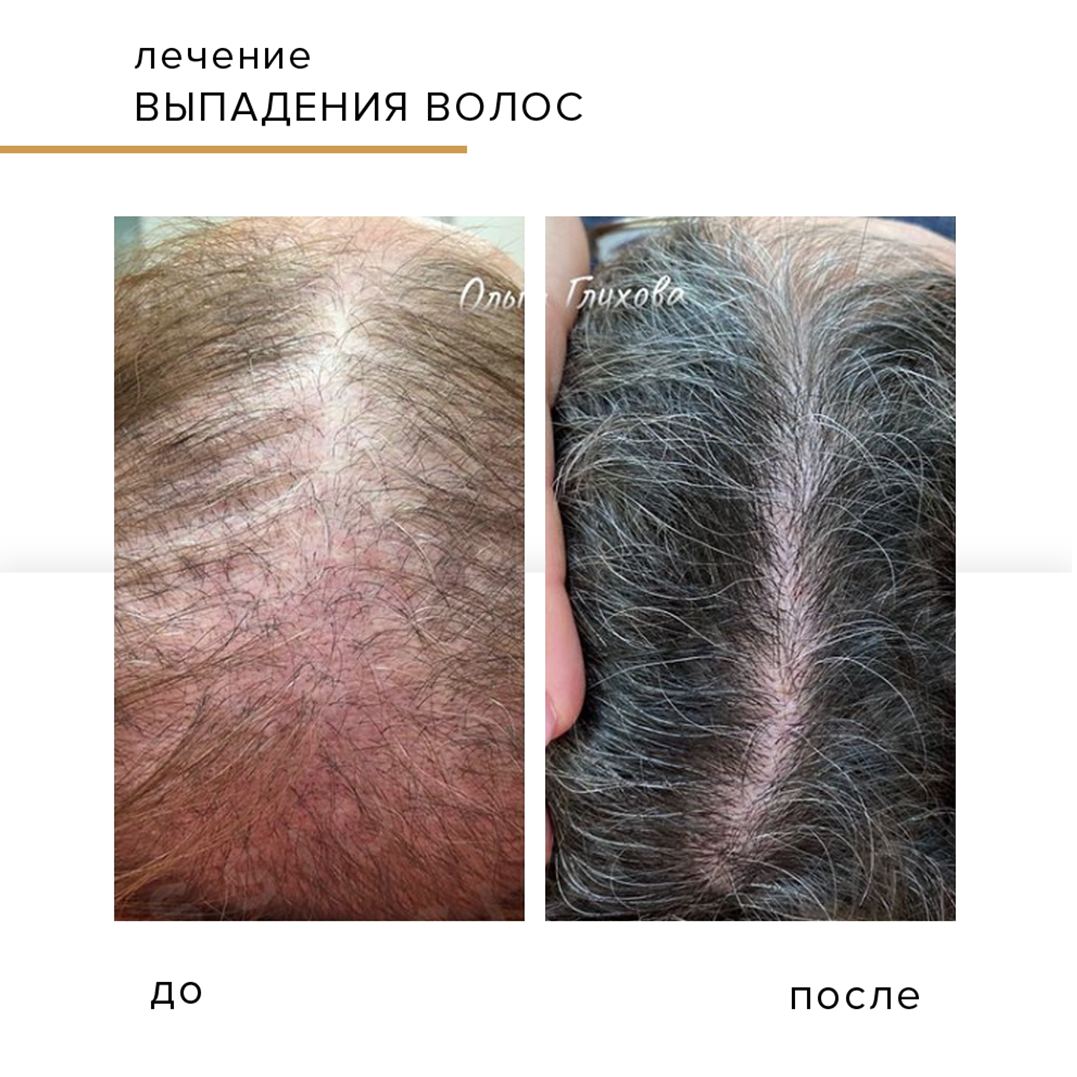 Волосы выпадают после лечения. Выпадение волос после Covid-19. Трихология выпадение волос. Выпадение волос после коронавируса.