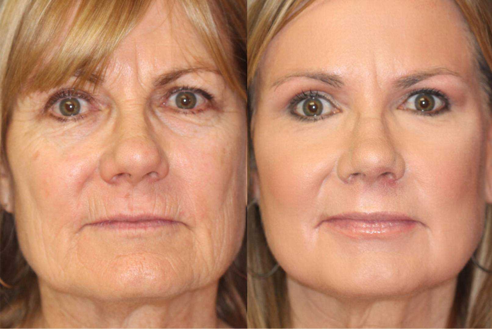 Процедура для лица после 60. Глубокий химический пилинг лица. Лицо с морщинами до и после. Ботокс для лица до и после. Омоложение лица.