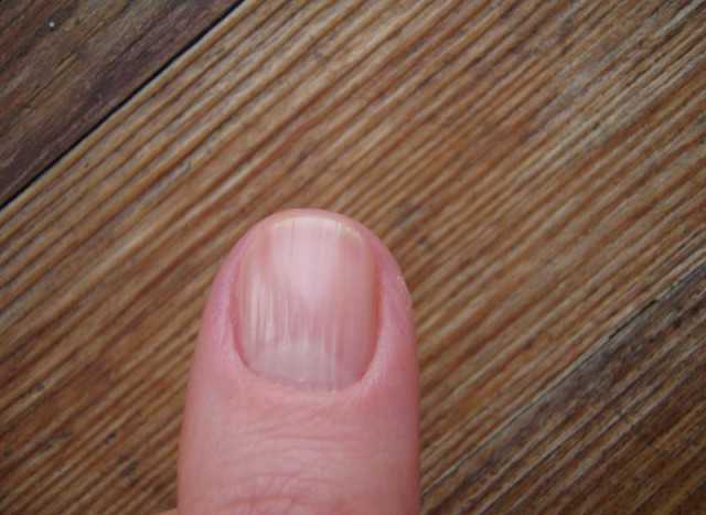 Желтые ногти: у женщин и мужчин, причины, после лака, как избавиться от желтизны, как отбелить желтое пятно под ногтем