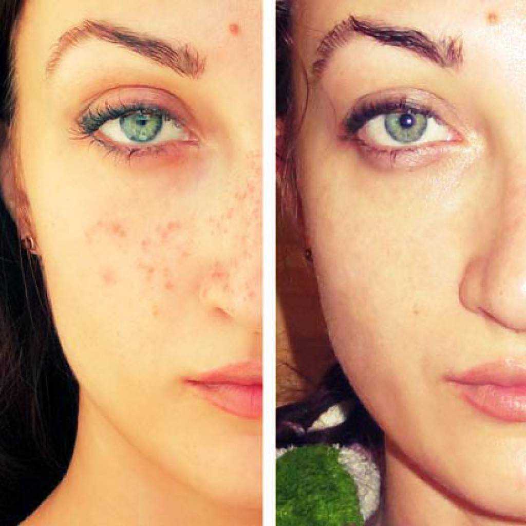 Пятен удалить лица. Отбеливание кожи лазером. Лазерное отбеливание кожи до и после. Пигментация на лице до и после.