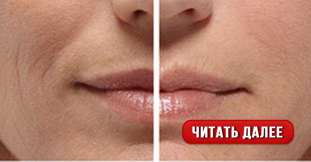 7 способов убрать кисетные морщины вокруг рта