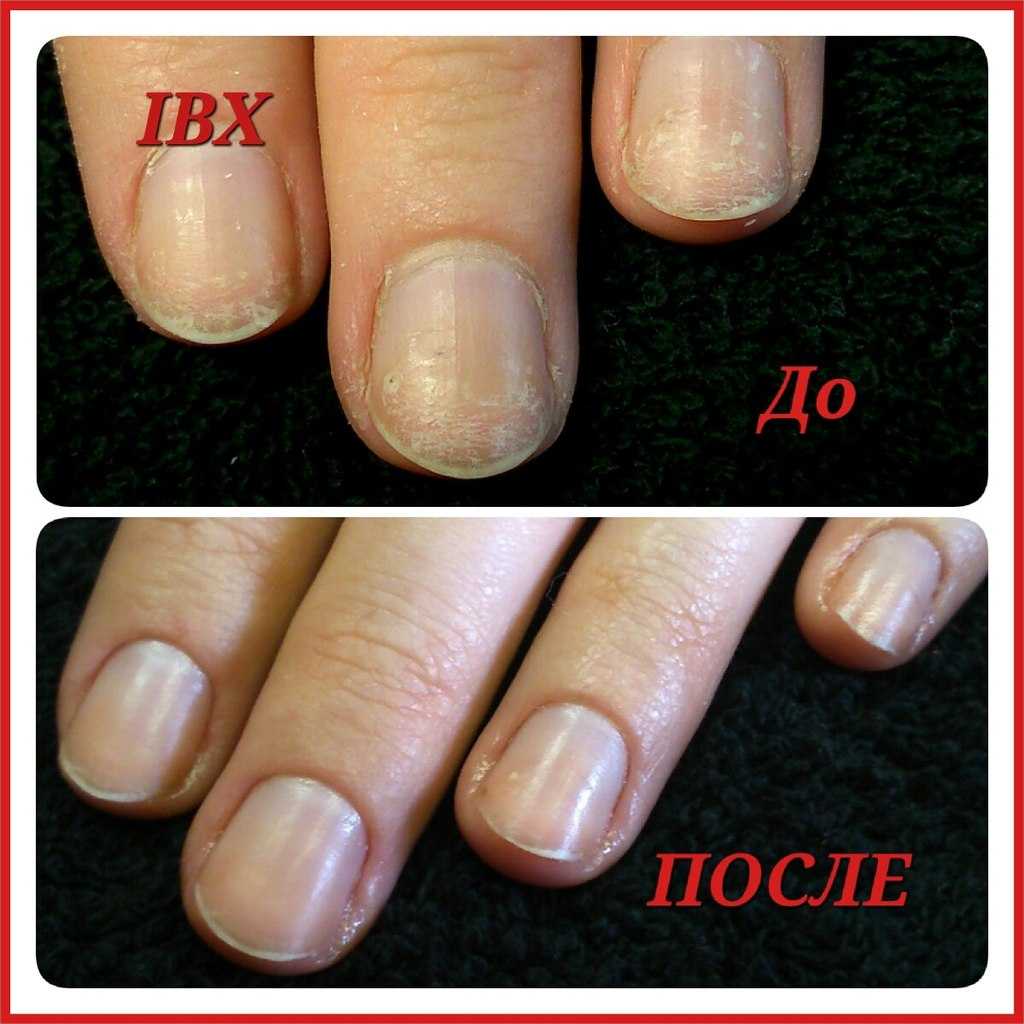 Как восстановить ногти после шеллака – лечение ногтей после гель-лака