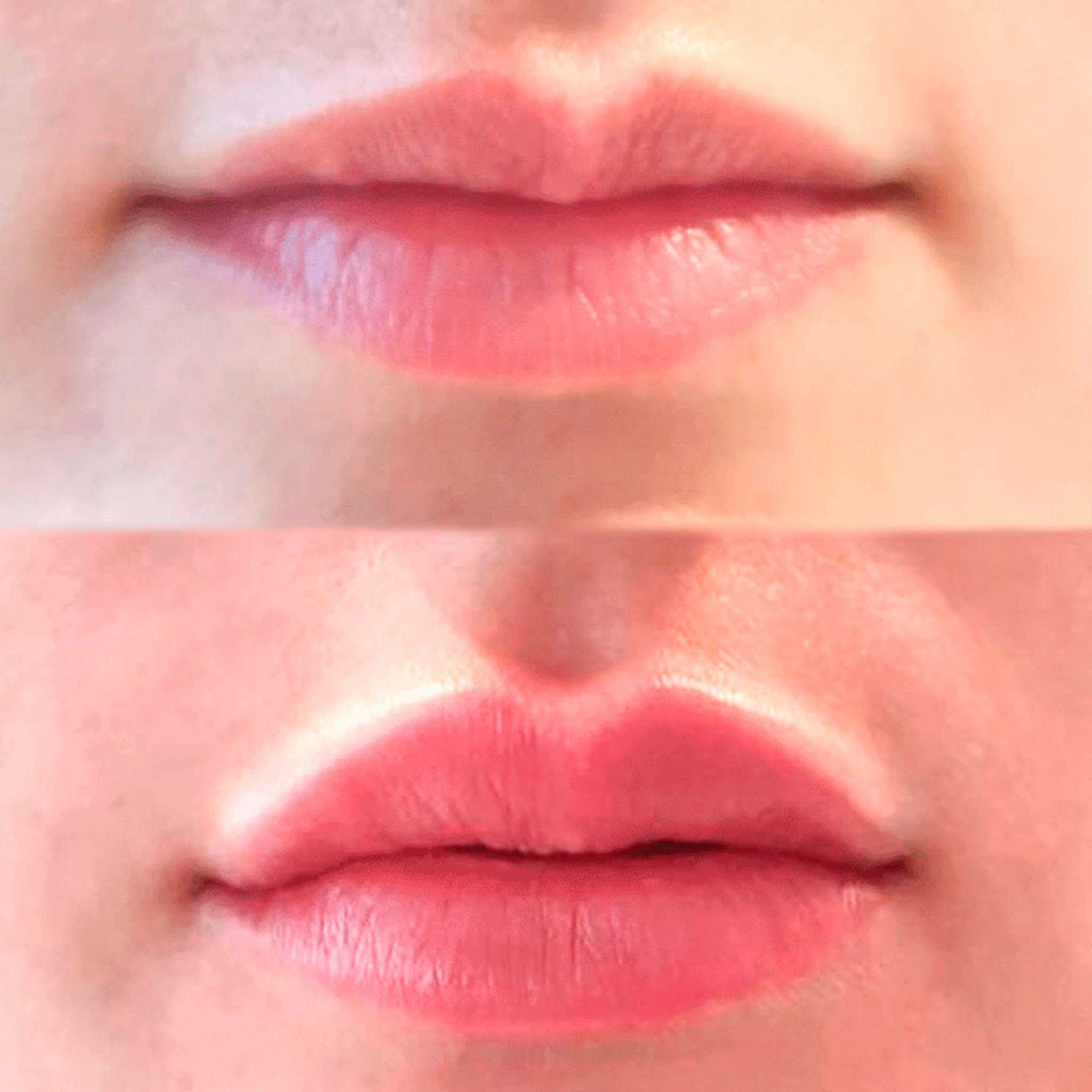 Увлажнение губ до и после. Контуринг губ гиалуроновой кислотой. Губы накаченные гиалуроновой кислотой 1 мл. Увлажнение губ гиалуроновой кислотой. Губы бантиком гиалуроновой кислотой.